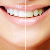 Comparison of teeth before and after whitening treatment.